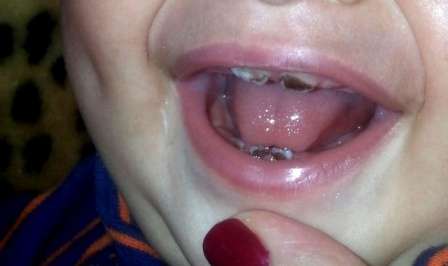 Почему у ребёнка почернели зубы